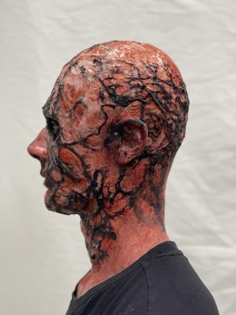 A person with realistic trauma special effects makeup resembling severe burns and exposed veins on their head and neck, wearing a black shirt, is shown in profile against a plain, light medical background.