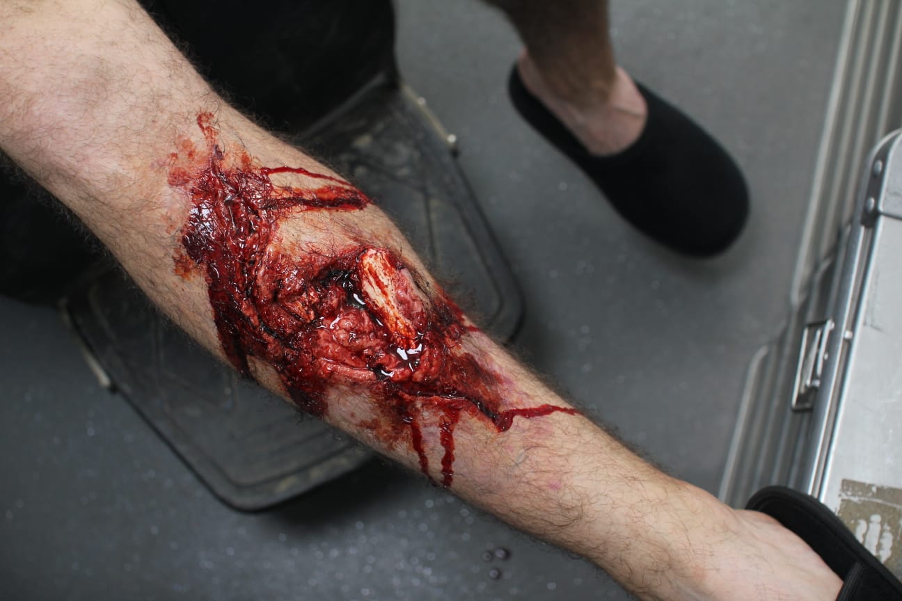 A close-up of a person’s lower arm shows a large, deep trauma wound exposing tissue and possibly bone. The injury is severe and graphic, indicating a serious medical emergency that requires immediate attention.