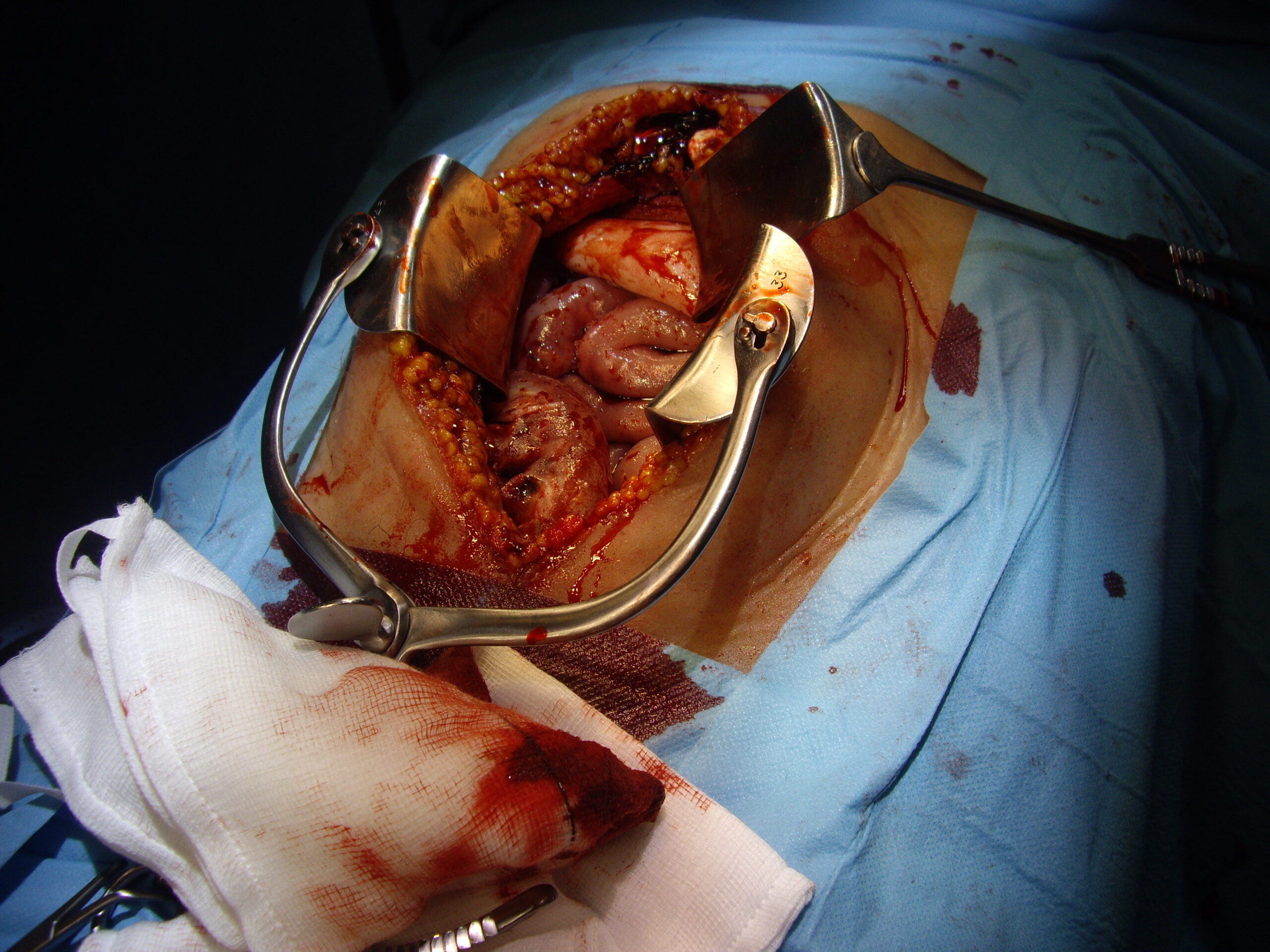 A close-up of an open abdominal surgery site shows surgical retractors holding the incision open, exposing internal organs. Blood and medical instruments are visible, with the patient covered in blue sterile drapes—suggesting a possible trauma procedure.