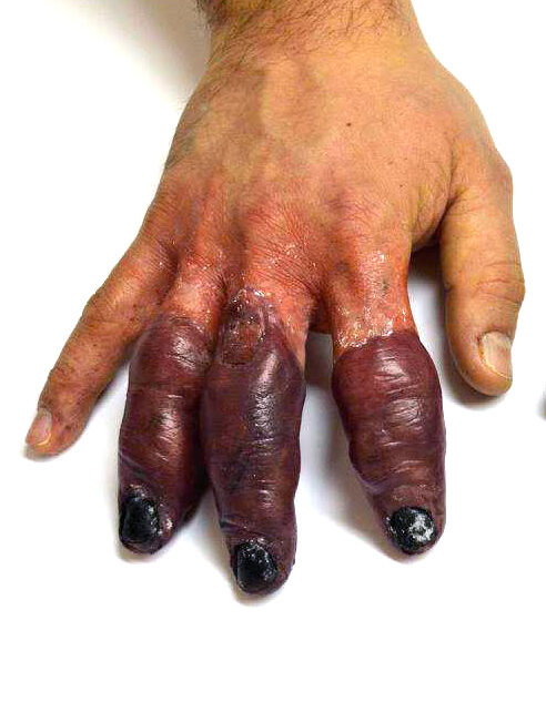 A medical image shows a hand with three fingers exhibiting severe black discoloration, swelling, and damaged nails, suggesting possible tissue trauma or gangrene; the inflamed skin appears unhealthy.